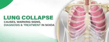Lung Collapse – Causes, Warning Signs, Diagnosis & Treatment in Noida