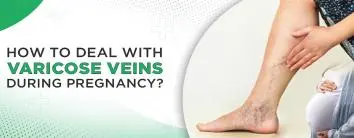 How to Deal with Varicose Veins during Pregnancy?