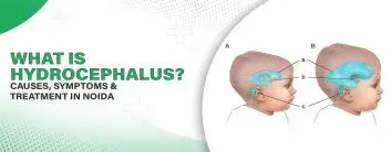 What is Hydrocephalus