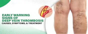 Signs of Deep Vein Thrombosis