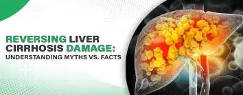 Reversing Liver Cirrhosis Damage: Understanding Myths vs. Facts