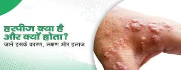 हरपीज क्या है और क्यों होता है? कारण, लक्षण और इलाज