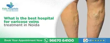  best hospital for varicose veins treatment in Noida