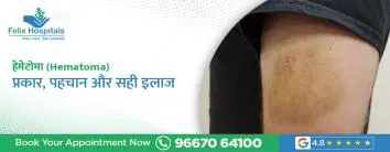हेमेटोमा (Hematoma) : प्रकार, पहचान और सही इलाज