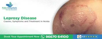 Leprosy Disease: Causes, Symptoms and Treatment in Noida